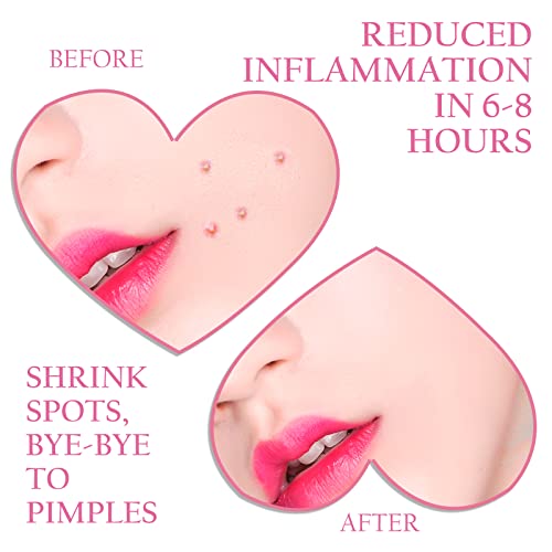 Acne-Fighting Tea Tree Oil Before and After Photos - Image 2